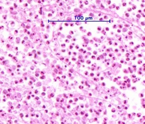 Meningitis- szövettan Neutrophil