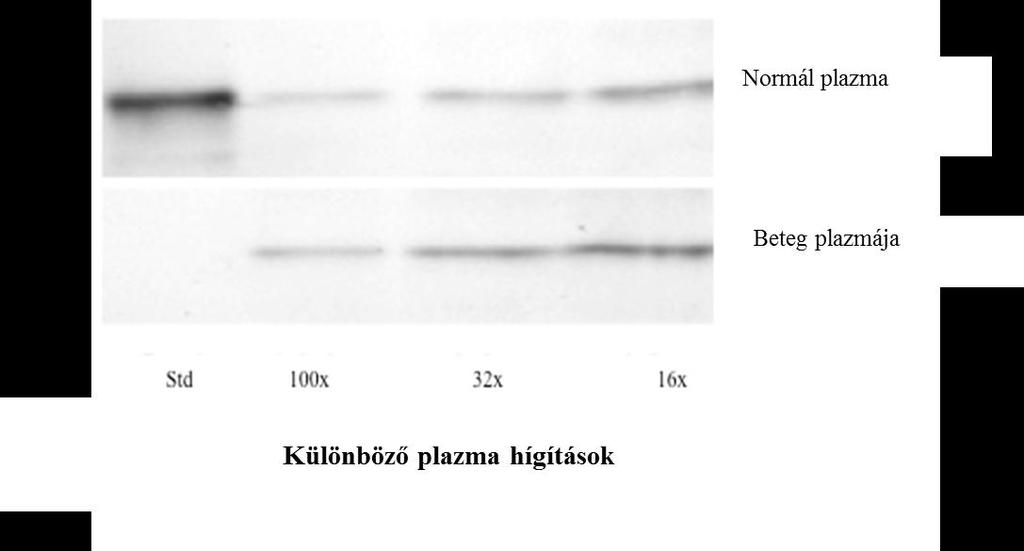 15. ábra. Az FXIII-A kimutatása normál, illetve a 2. beteg plazmájából Western blotting technikával.