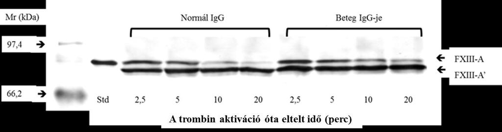 18. ábra. Az AP-FXIII lehasítása trombinnal normál IgG és a 2. beteg IgG-jének jelenlétében Western blotting technikával követve. Az egyes sávok 40 ng plazma FXIII-nak felelnek meg.