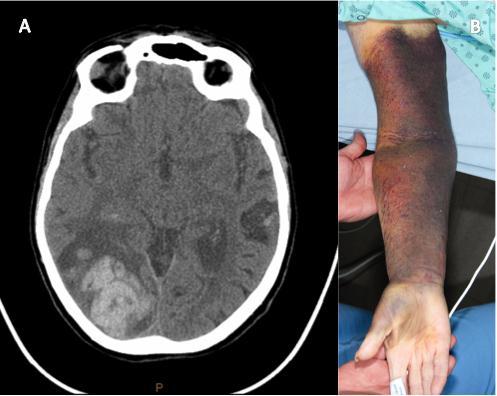 21. ábra. Az FXIII deficiencia klinikai következményei a harmadik betegnél. (A) A koponya computer tomográfiás vizsgálata bal oldali nyakszirti vérzéses stroke-ot mutatott.