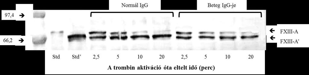 27. ábra. Az AP-FXIII lehasítása trombinnal normál IgG és a 3. beteg IgG-jének a jelenlétében Western blotting technikával követve. Az egyes sávok 40 ng plazma FXIII-nak felelnek meg.