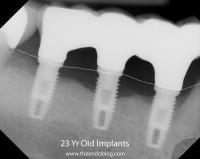 implantátum nem képes mozogni az