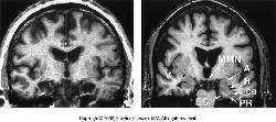 striatum (accumbens) jutalom (dopamin) - Parkinson-kór, addiktológia, szkizofrénia -Érzelmek, félelem, társas jelzések feldolgozása - Hangulatzavarok, szorongásos zavarok -Tudatos emlékezés