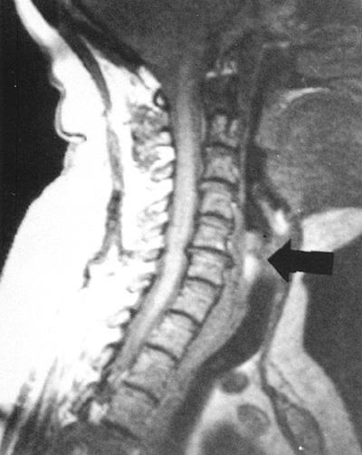 MRI: C5-6