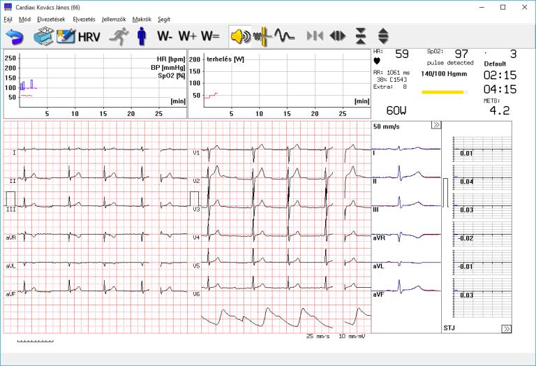 A terheléses EKG monitor Kerékpár esetén: A terheléses EKG monitor Futószalag esetén: A futó görbék fölötti területen a szívfrekvencia-vérnyomás és a