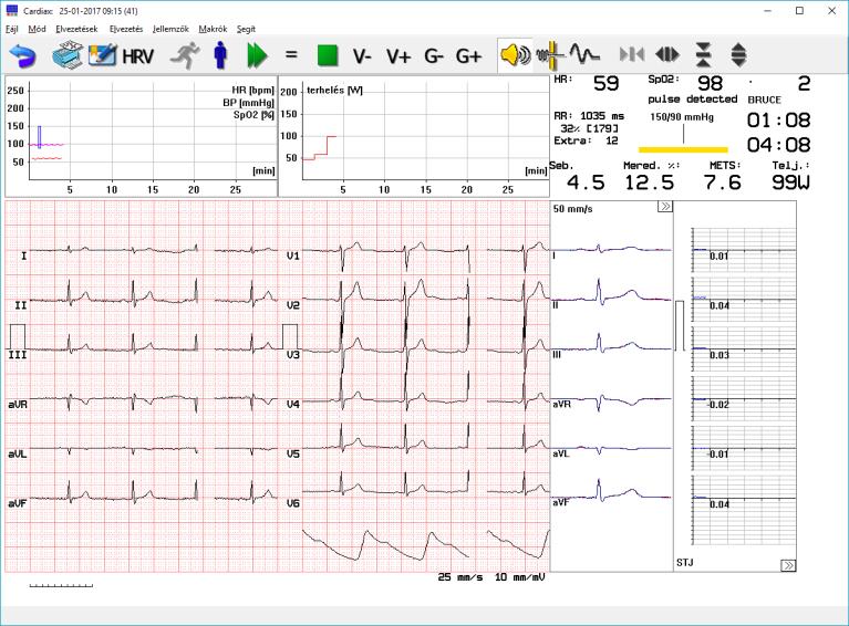 Az EKG görbék jobb oldalán a mediánok és az ST amplitúdók láthatók.
