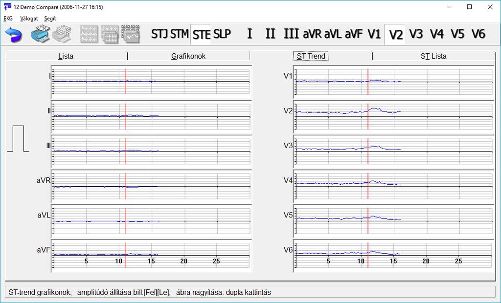 11.3 ST kiértékelés ST-Trend A képernyőn a 12 standard elvezetés ST diagramjai láthatók az idő függvényében. Az első pihenő fázis kezdetét a piros vonal jelöli.