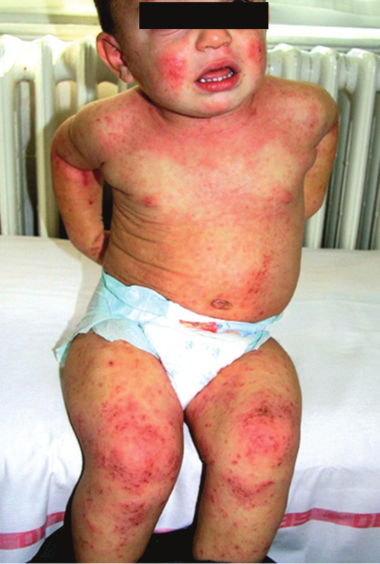 ÖSSZEFOGLALÓ KÖZLEMÉNY 01. ÁBRA Az atópiás dermatitisz csecsemőkori (a), gyermekkori (b) és felnőttkori (c) klinikai képe.
