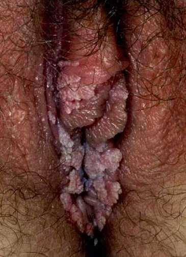 HPV and Anogenital Warts Images top left and top right: Reprinted with