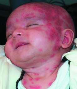 Neonatalis lupus - Bőrtünetek születéskor, vagy az után néhány nappal jelentkező