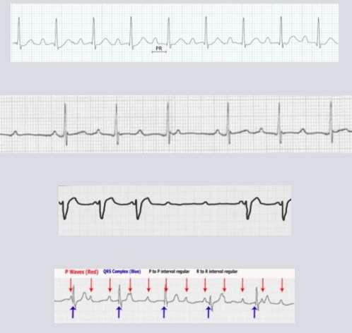 Neonatalis lupus cardialis manifesztáció Congenitalis szívblokk: 66%-ban pacemakert igényel. Leggyakrabban komplett, de I. vagy II.