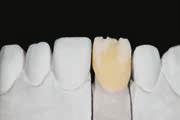 14 Tisztítás A zsugorodás ellensúlyozására 10%-kal nagyobbra kell építeni a fogformát, mint az elérni kívánt méret.