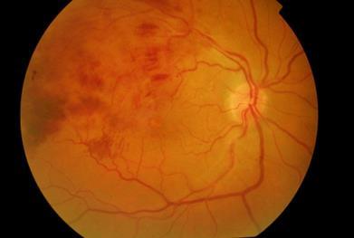 Retinalis vénás keringészavarok Fájdalommentes, hirtelen látásromlás a vascularis eredetű súlyos látáskárosodás 2.
