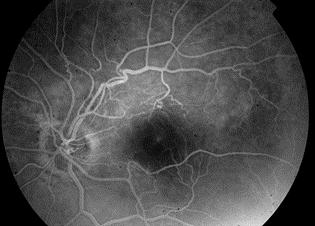 vérzések Perzisztáló macula oedema: a látásromlás fő oka