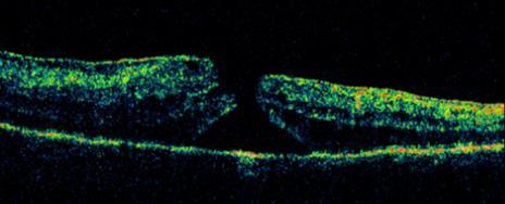 üvegtesti, preretinalis vérzés, tracts retina leválás