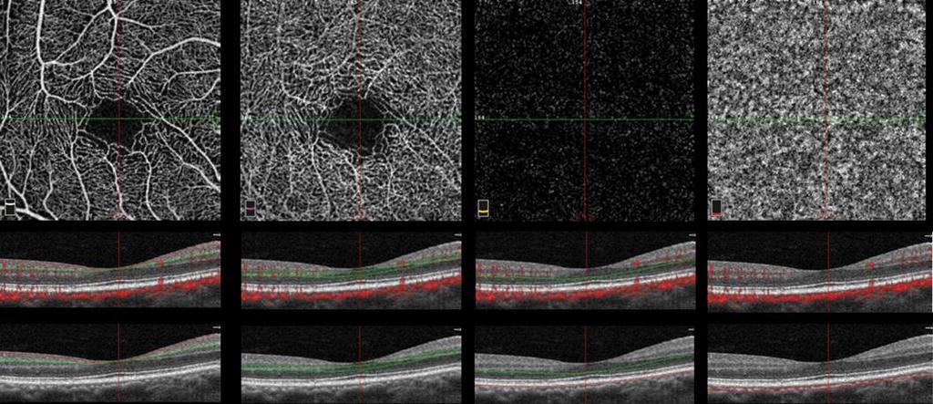 horizontális vonalat Cilioretinalis artériák Art ciliares post breves Papilla temp szélénél Kapilláris