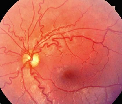Krónikus hypertensive retinopathia: Differenciál diagnosztika Szemészet Diabeteses retinopathia Vénás keringészavar Hyperviszkozitás szindróma Kongenitalis herediter artériás tortuozitás Okularis