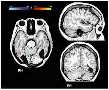 Háttér TBI, stroke Differenciáldiagnózist igényel Perceptuális képességek Látás Élesség