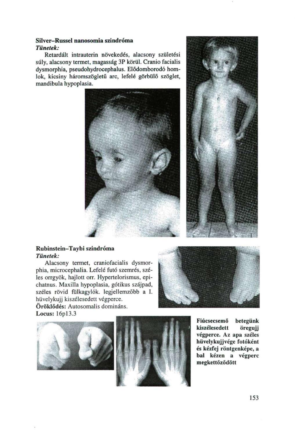 Silver-Russel nanosomia szindróma Tünetek: Retardált intrauterin növekedés, alacsony születési súly, alacsony termet, magasság 3P körül, Cranio facialis dysmorphia, pseudohydrocephalus.