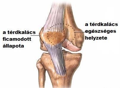Térdkalács ficama/luxatio patellae: 15.