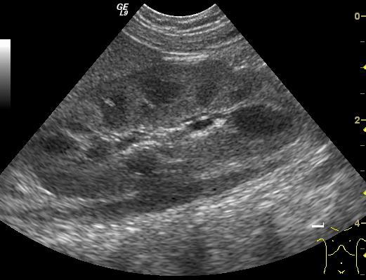Ultrahangvizsgálat vese: nagyság,parenchymaszerkezet Ureter: normálisan nem, vagy alig látható Hólyag: telt állapotban, falvastagság,