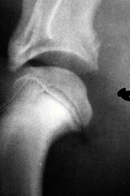 Osteochondrosis dissecans