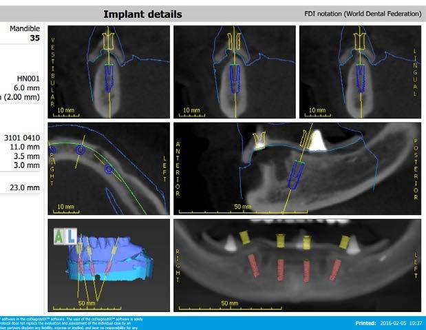 síkja alá kell helyezni az implantátumokat ott, ahol nagy a tengelyeltérés) ennél az implantátumnál csak nagyon korlátozottan érvényesült (13. ábra).