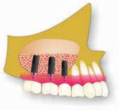 Például a szájpadlás felett található üreg, (simus maxillaris) tehát arcüreg az őrlőfogak esetében megakadályozhatja az implantációs beavatkozást.