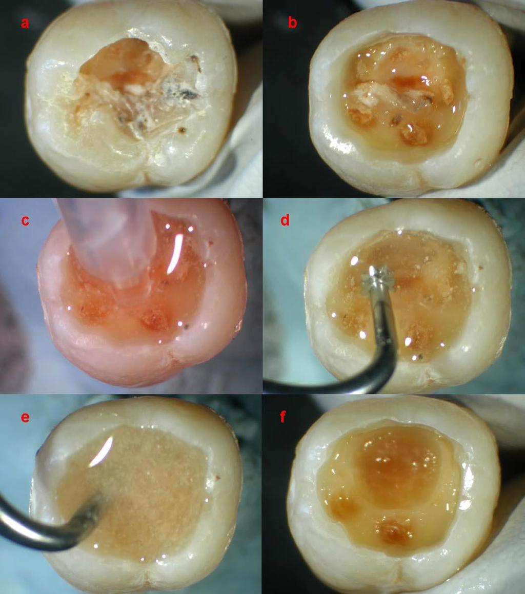 Caries removal using chemo-mechanical CarisolvTM gel. (a) The original occlusally cavitated carious lesion in a mandibular molar.