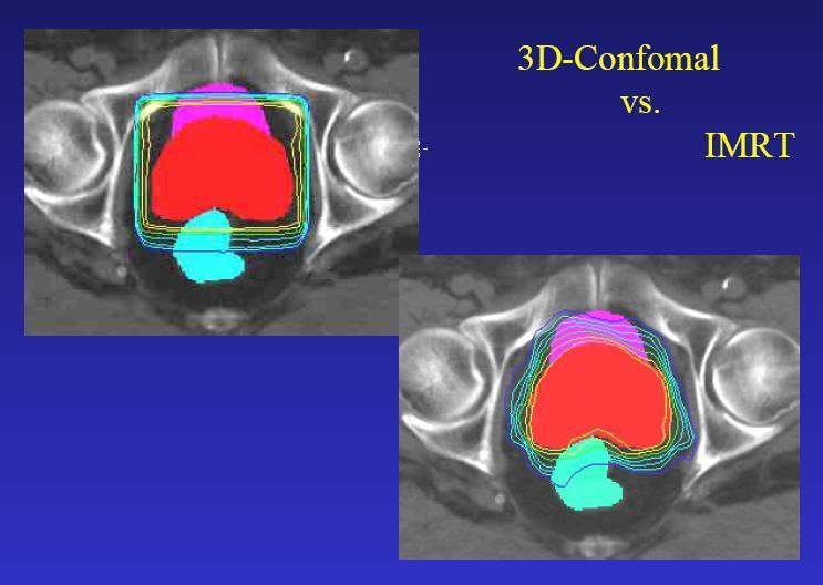 Az IMRT előnye prosztatarák