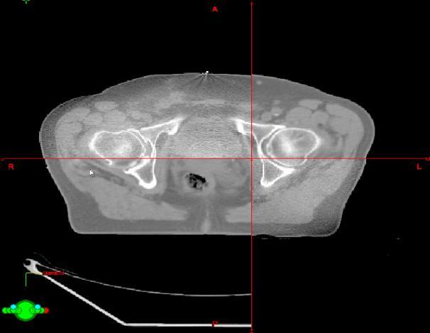 Kezeléskor CBCT Split módban coregisztráció