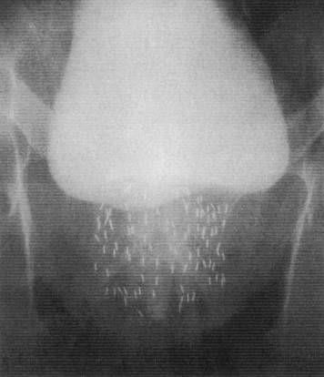 Permanens ( seed ) implantáció Low