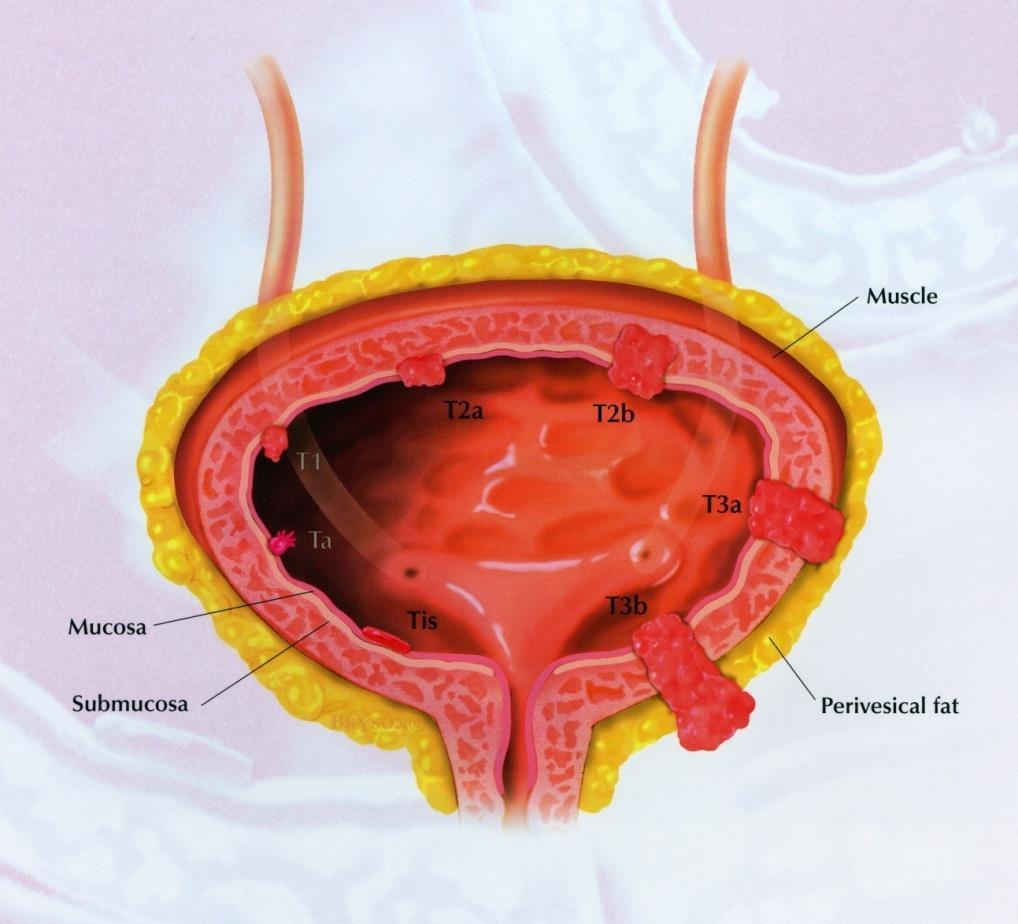 Hólyagrák kezelése Izominvazív hólyagrák pt2-4 Cystectomia Partialis Simplex Radicalis