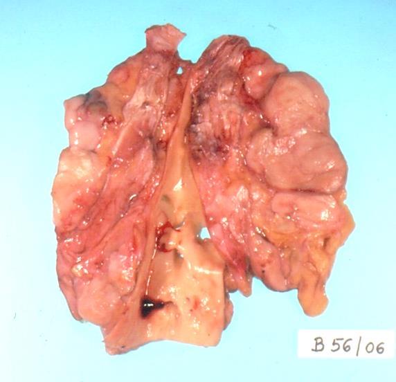 A lymphoid rendszer betegségei CLL / SLL CLL / SLL