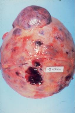 multiplex, plasmocytoma