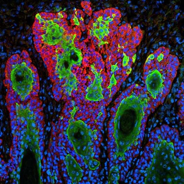 Laphámsejtes carcinoma Laphámdaganat-sejtekForrás: Flickr/NIH