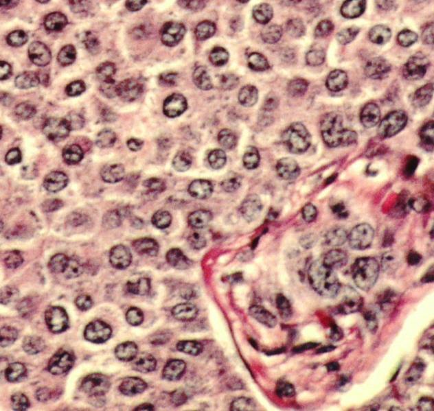 carcinoma (2.4%) Medulláris carcinoma (1.
