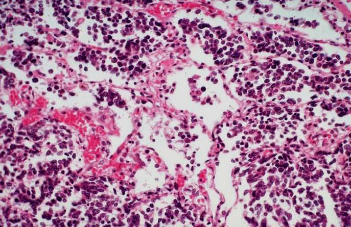 Kissejtes rák MYCL1: ampl, N-MYC: amp FGFR1: ampl SLIT2: mutáció EPHA7: mutáció CREB: mutáció MLL: