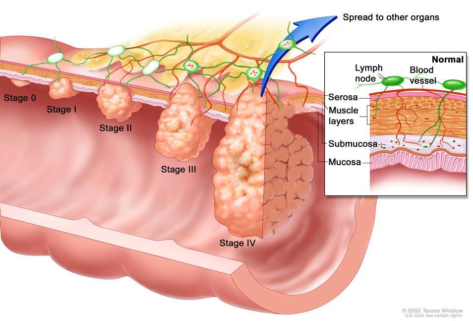 Colorectalis rákok