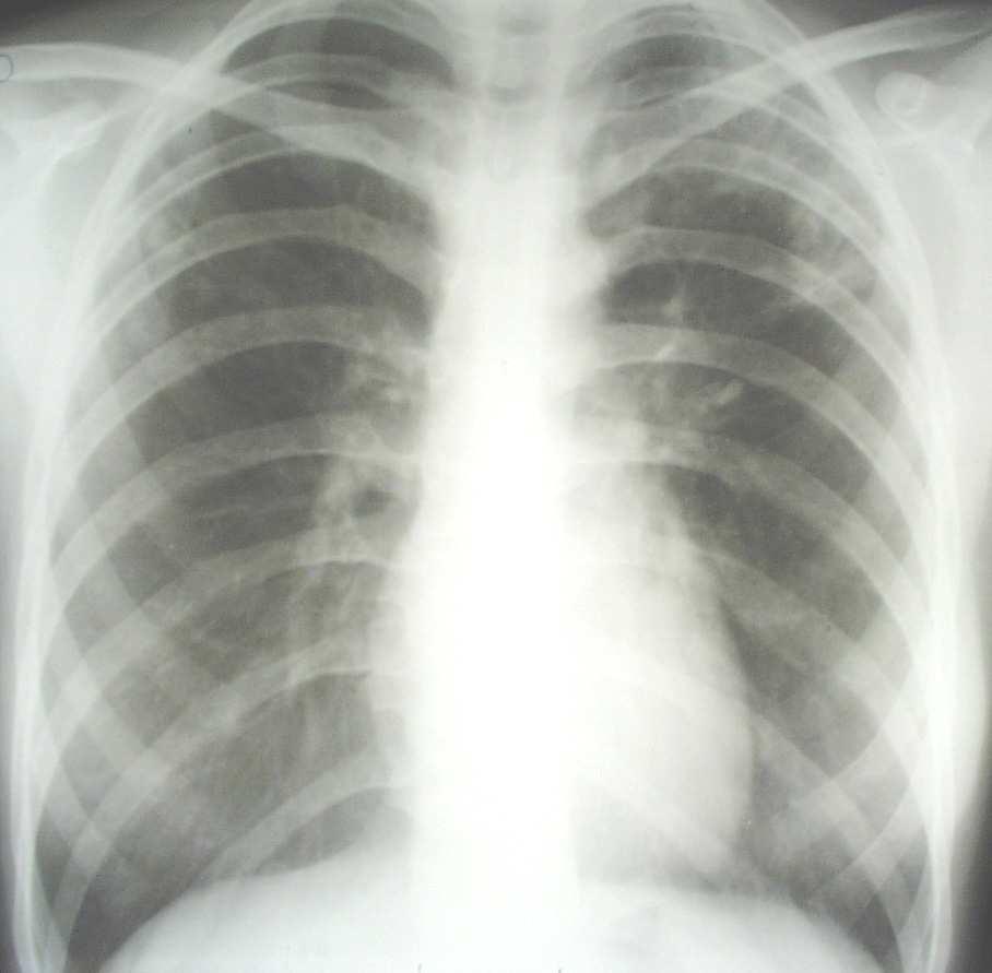Felnıtt típusú tuberculosis - postprimér -