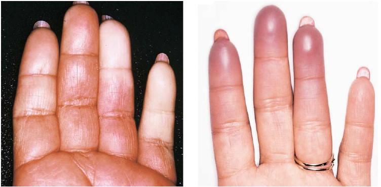 1. Ábra. Primer Raynaud szindrómás beteg kézfelvétele: bal oldalon asphyxia fázisa, jobb oldalon hyperaemia fázisa (Dr. Csiki Zoltán anyagából) 2.