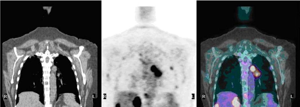 PET/CT modalitás Rekonstrukció