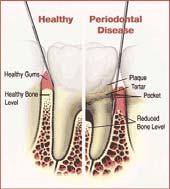 A parodontális kezelés célja Teljeskörű parodontális kezelés lépései 1) Stabil parodoncium létrehozása (mély tasakok megszüntetése) 2) A páciens által hosszú távon tisztán tartható felszínek