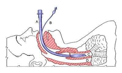 Intubáció