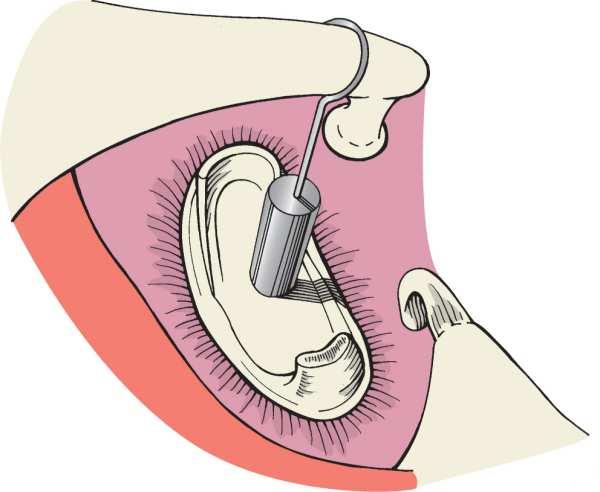 stapedotomia 2 Laser a szájüreg-