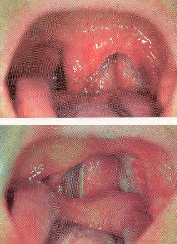 Tonsillectomia-tonsillotomia