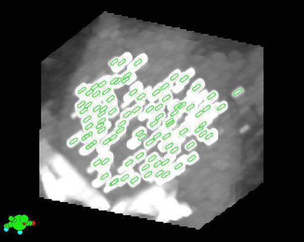 Seed-technika - permanens beültetések: Very LDR seed-ek (I-125) PBSI