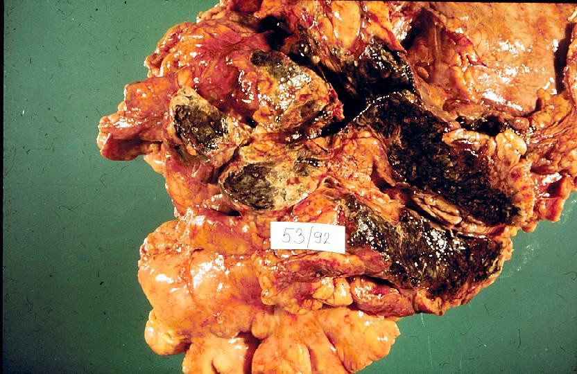 Apoplexia agy pancreas