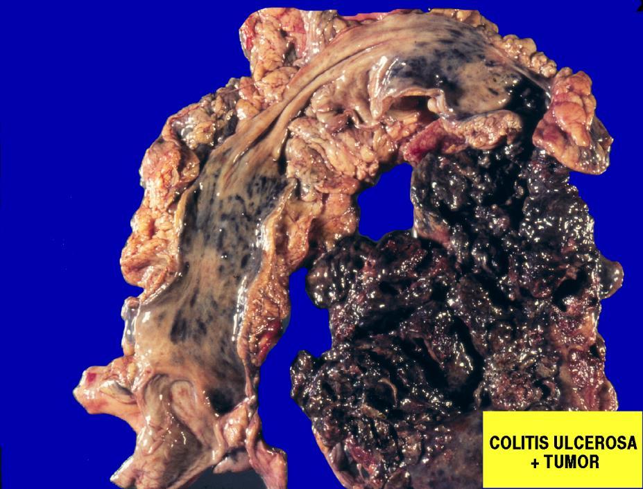 nyálkahártya-atrophia toxicus megacolon