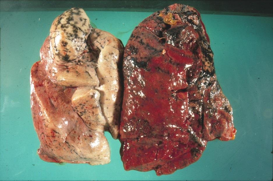 emphysema